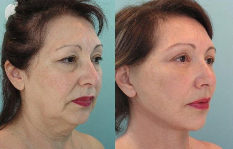 The result of a rejuvenating facial skin tightening with threads