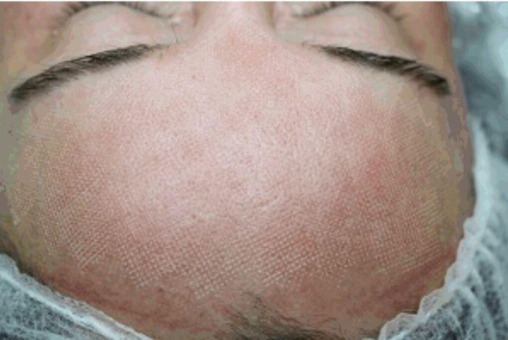 Redness and slight swelling of the skin after fractional laser