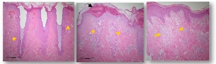 Skin changes under a microscope after fractional rejuvenation